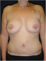 Beidseitiger Brustwiederaufbau mit Unterbauchfettgewebe (DIEP – Lappen)