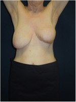 Ergebnis nach brusterhaltender Operation der linken Brust