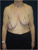 Einzeichnung der Schnittführung vor Korrektur der linken Brust und  angleichender Operation der rechten Brust (3 Monate nach der Bestrahlung) 