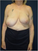  Ergebnis nach brusterhaltender Operation der linken Brust