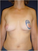 Einzeichnung der Schnittführung vor brusterhaltender Operation der linken Brust