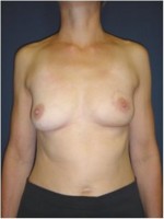 Ergebnis mehrere Monate nach brusterhaltender Operation der linken Brust