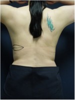 Einzeichnung der Schnittführung für einen Brustwiederaufbau mit Rückengewebe