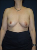 Ergebnis nach Brustwiederaufbau mit Rückengewebe