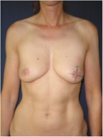 Einzeichnung der Schnittführung vor brusterhaltender Operation der linken Brust