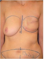 Ergebnis nach  Mastektomie der linken Brust