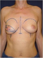 Einzeichnung der Schnittführung vor einer Mastektomie mit  Erhalt von Brustwarze und -vorhof und sofortigem Wiederaufbau mit einem Implantat. Zudem ist die Angleichung der linken Brust mit einem Implantat geplant