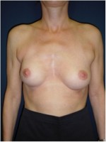 Ergebnis  nach Mastektomie mit Erhalt von Brustwarze und -vorhof und sofortigem Wiederaufbau mit einem Implantat. Zudem erfolgte eine Angleichung der linken Brust durch ein Implantat