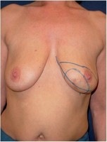 Einzeichnung der Schnittführung vor Mastektomie der linken Brust und sofortigem Wiederaufbau