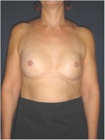 Beidseitiger Brustwiederaufbau durch Implantate 